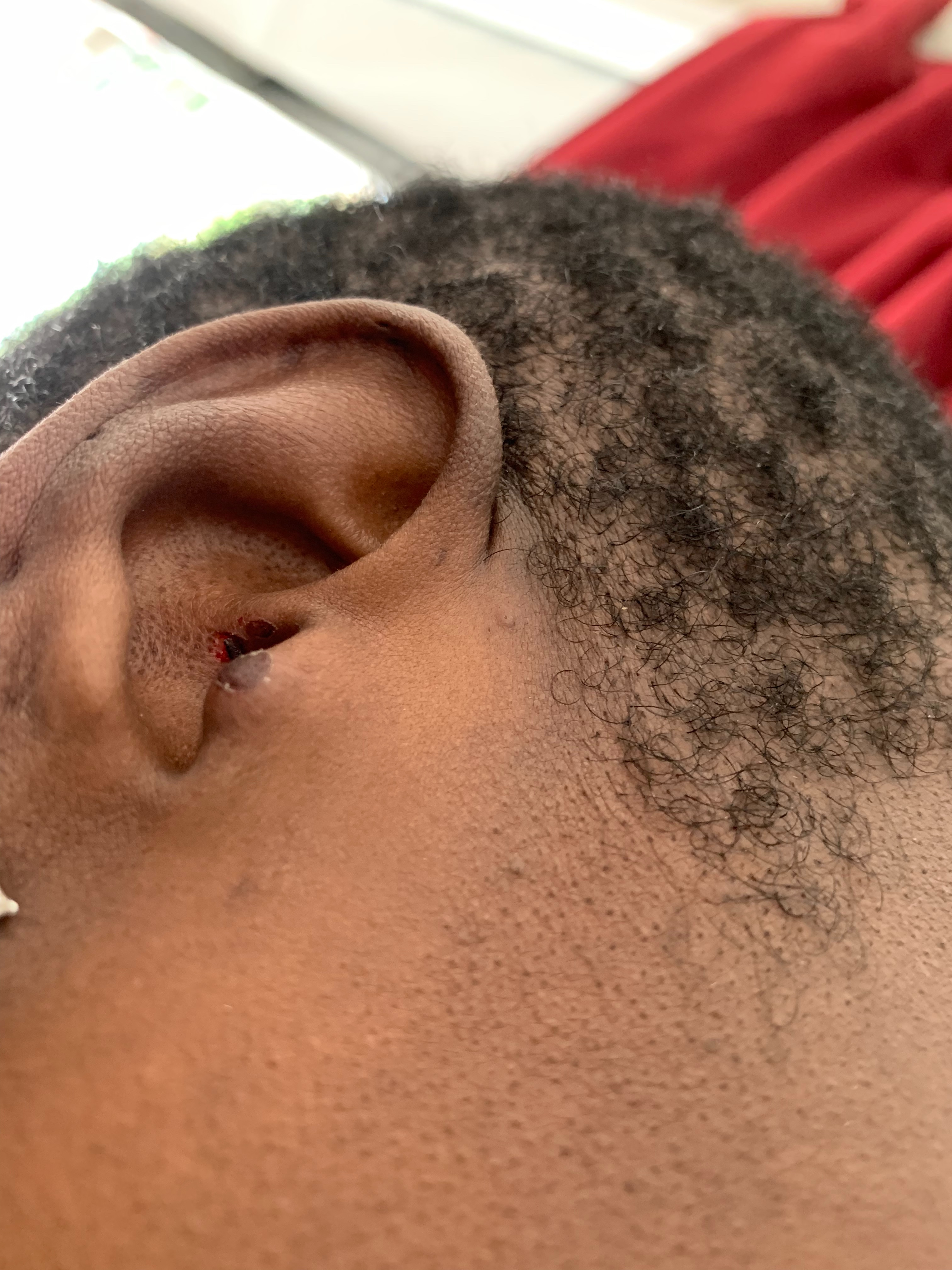 Earbuds Burnt/hurt my right ear Apple Community