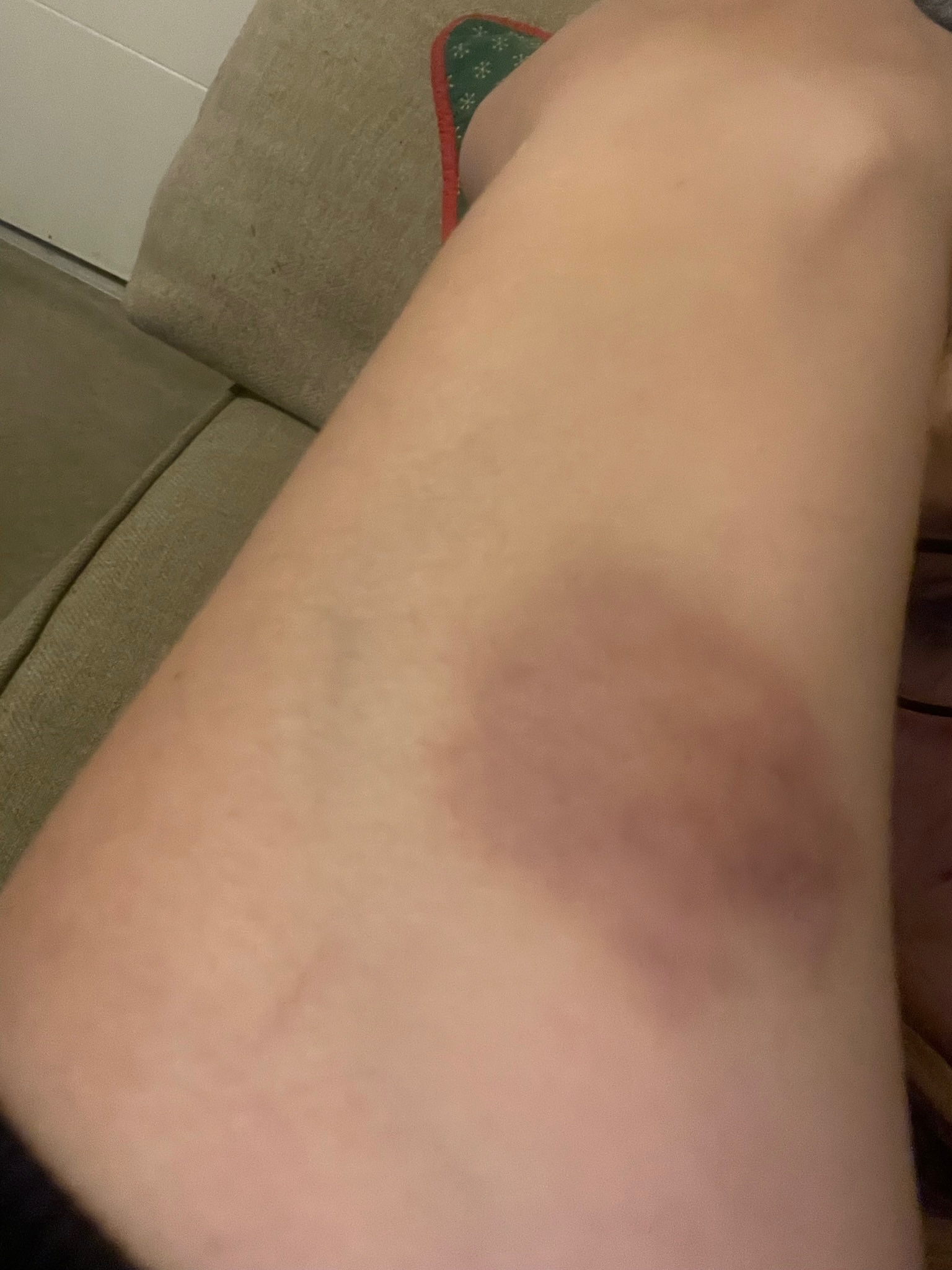 arm bruises