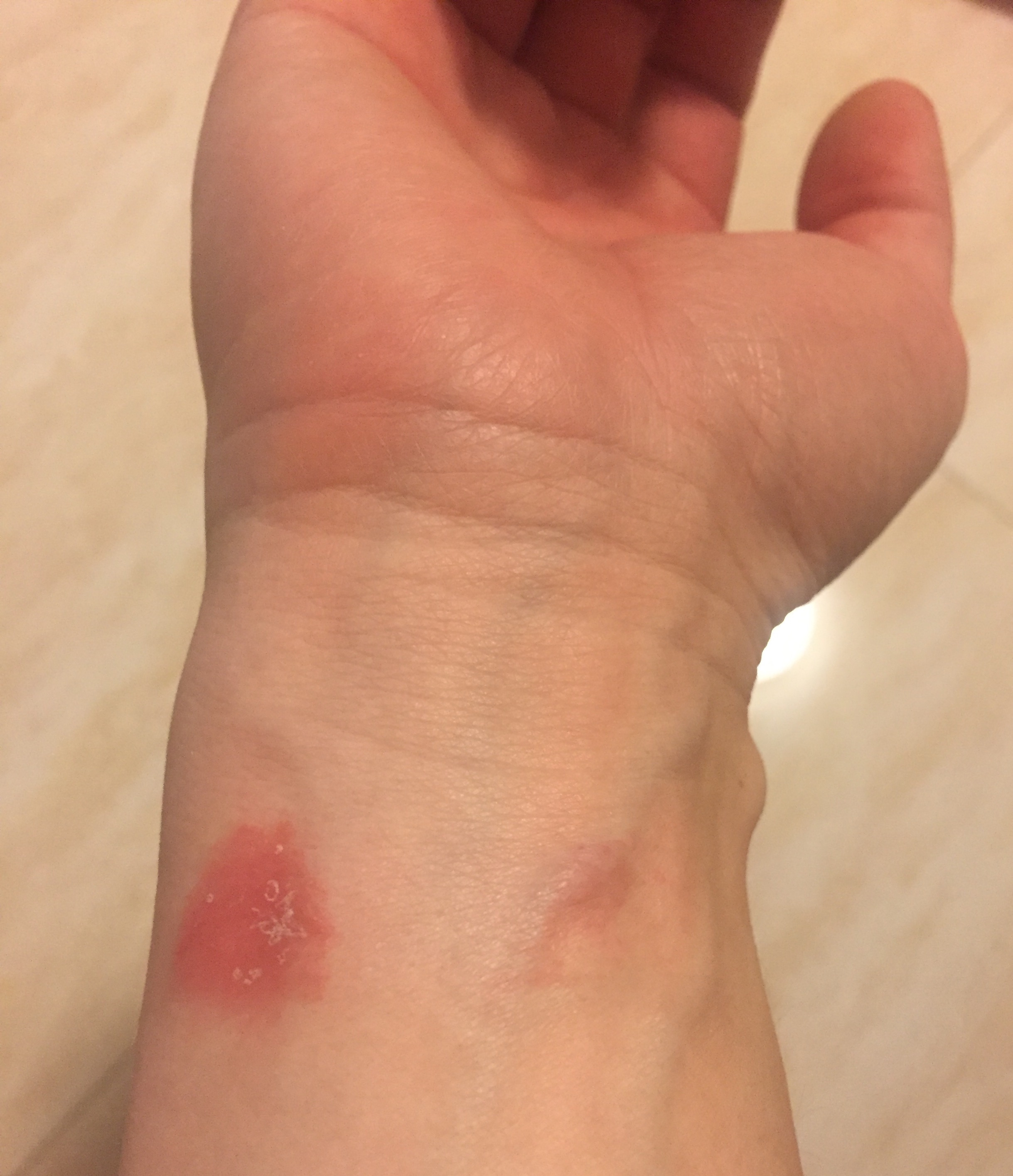 Sport Watch Band Caused Rash On My Wrist Apple Community