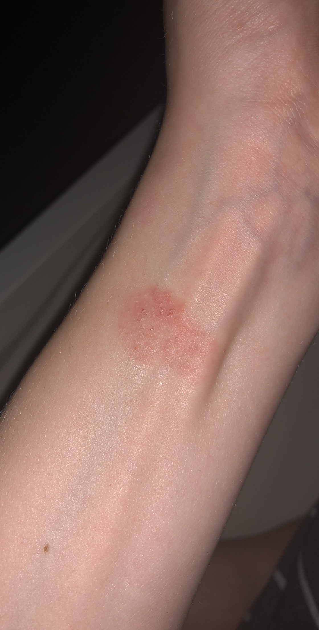What Caused This Rash? Apple Community