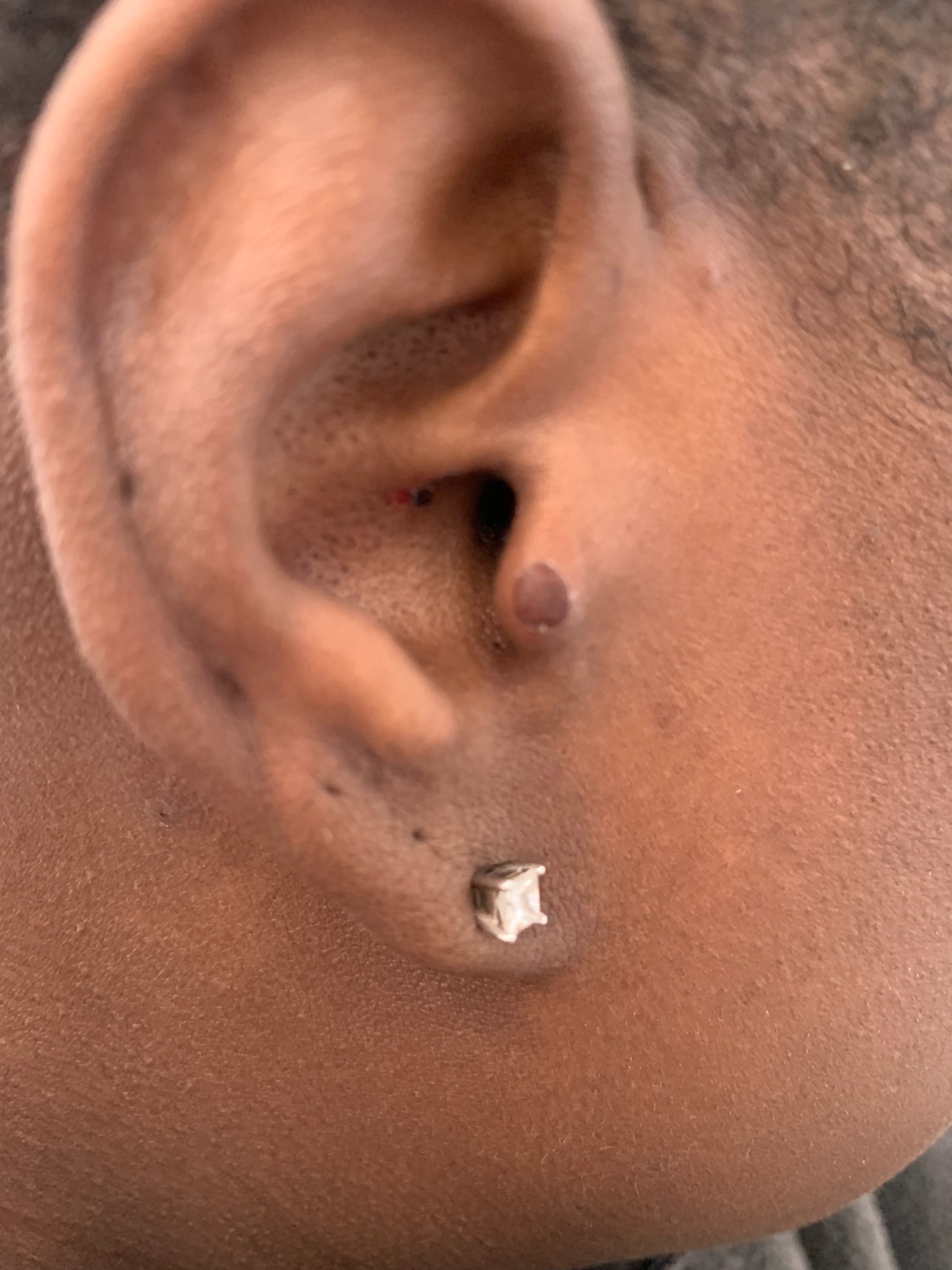 Earbuds Burnt Hurt My Right Ear Apple Community