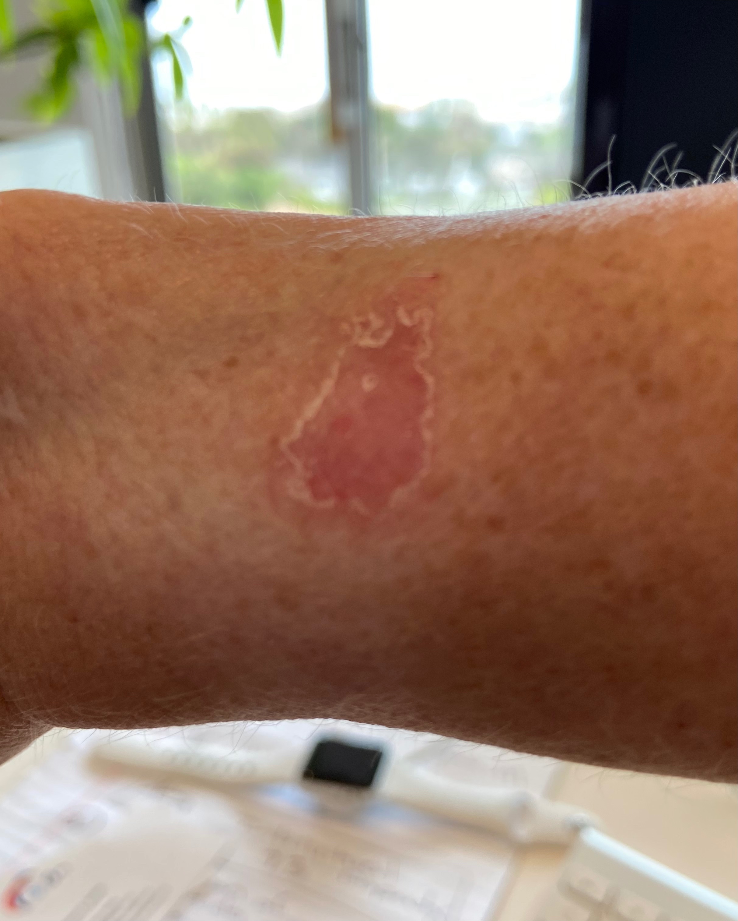 SKIN IRRITATION Apple Community